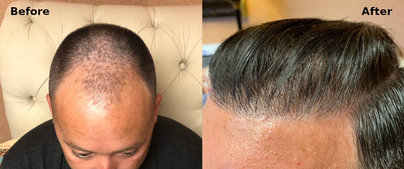 Top 7 Hair Transplant Clinics in Istanbul (in 2019) by  afroamericanhairtransplant - Issuu