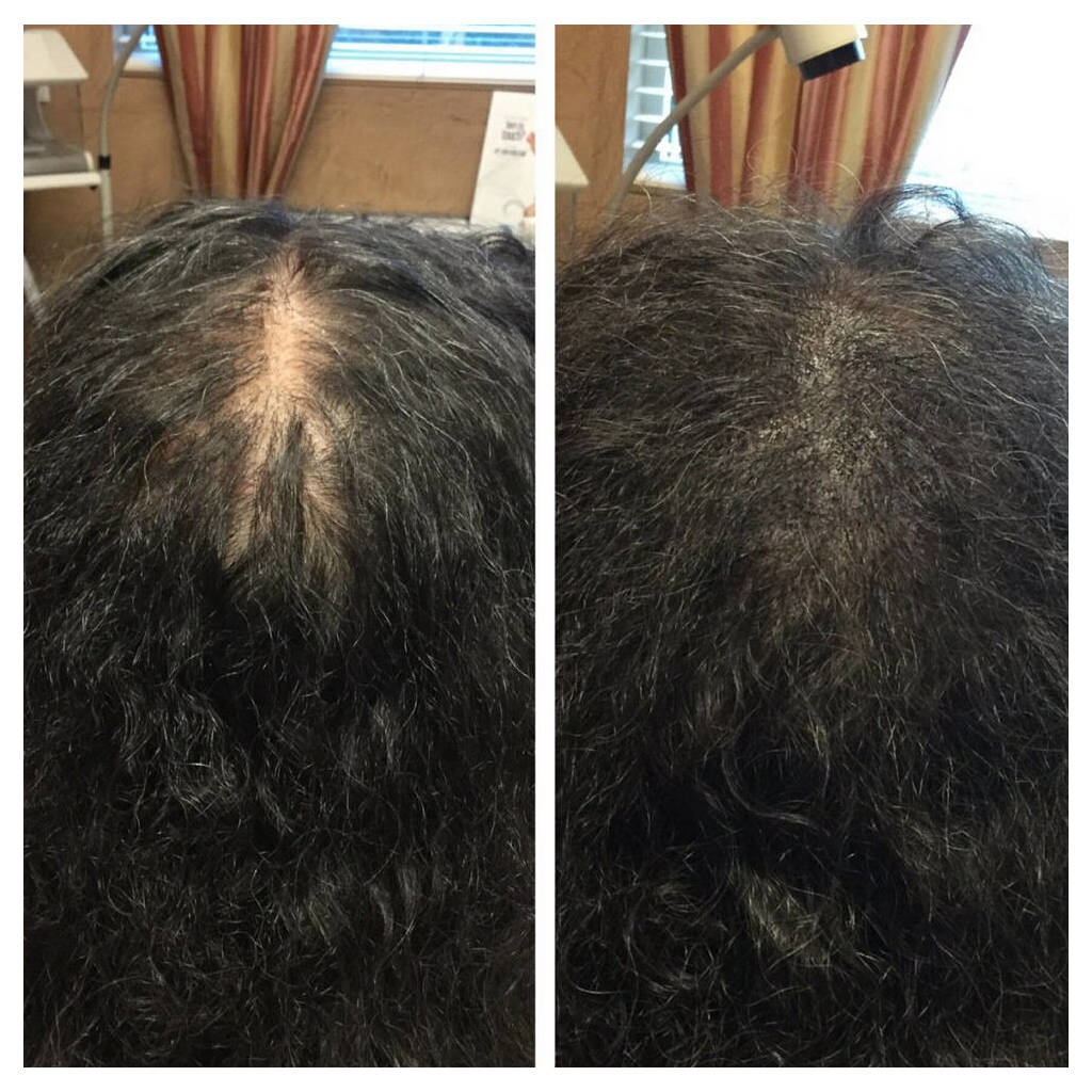 micropigmentation before and after