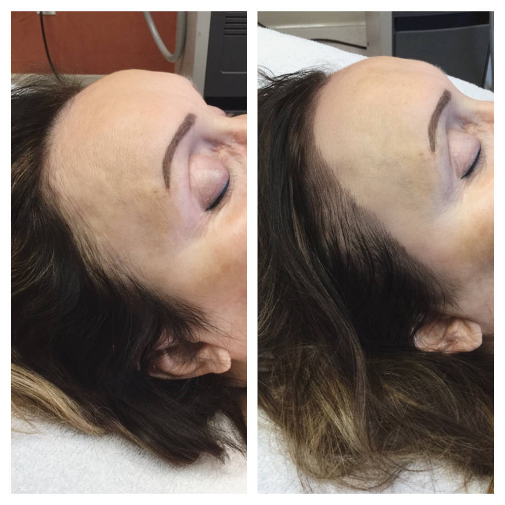 micropigmentation before and after