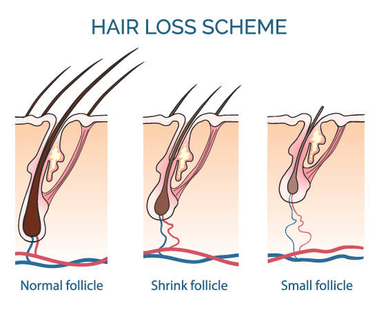 hair loss scheme