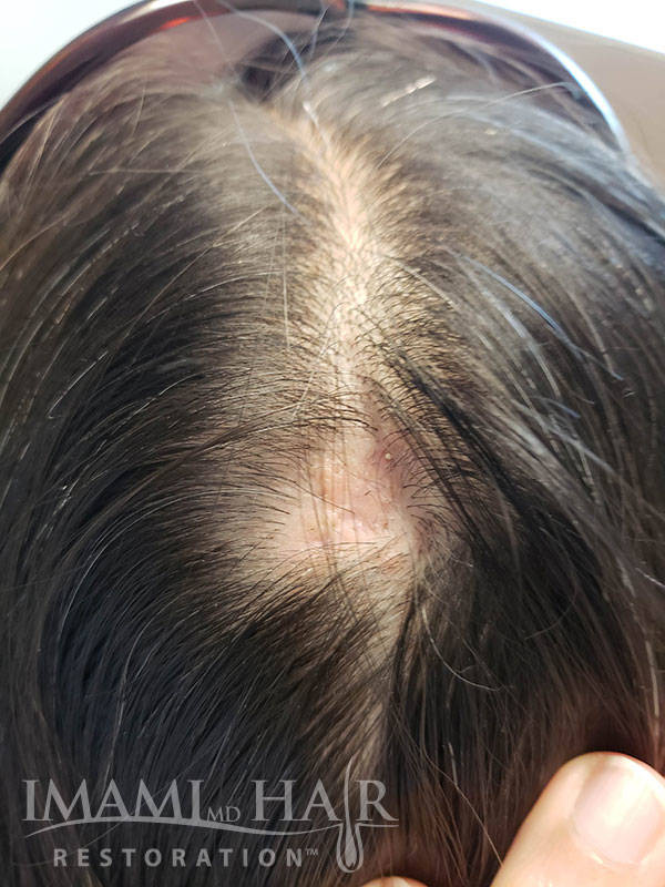 scarring alopecia