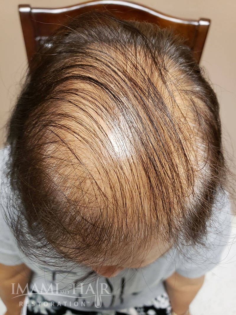 Severe Ludwig II Hair Loss