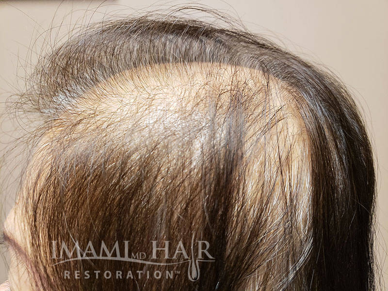 Severe Ludwig II Hair Loss