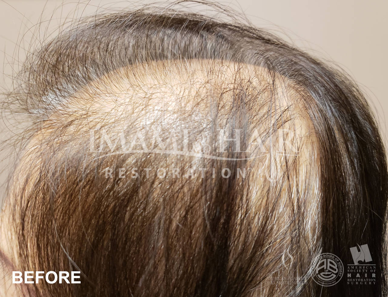 Hair Loss Grading - Imami Hair Restoration