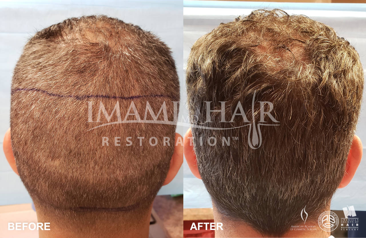 FUE with PRP Before and After 5 months, Back View