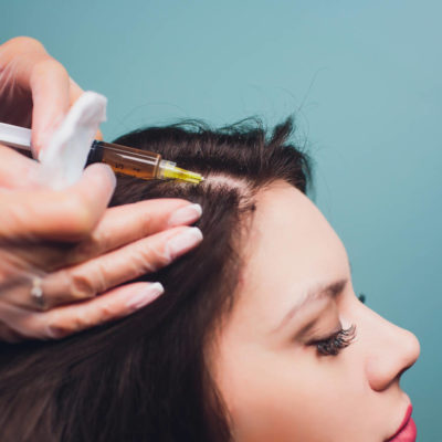 PRP scalp treatment