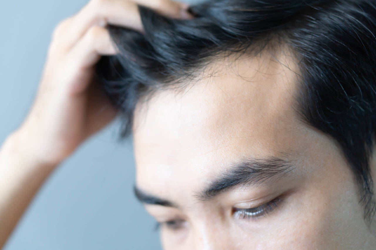 young male with hair loss
