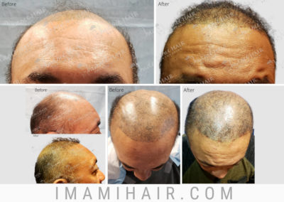 57 y/o Male: FUT for Scalp Micropigmentation Correction