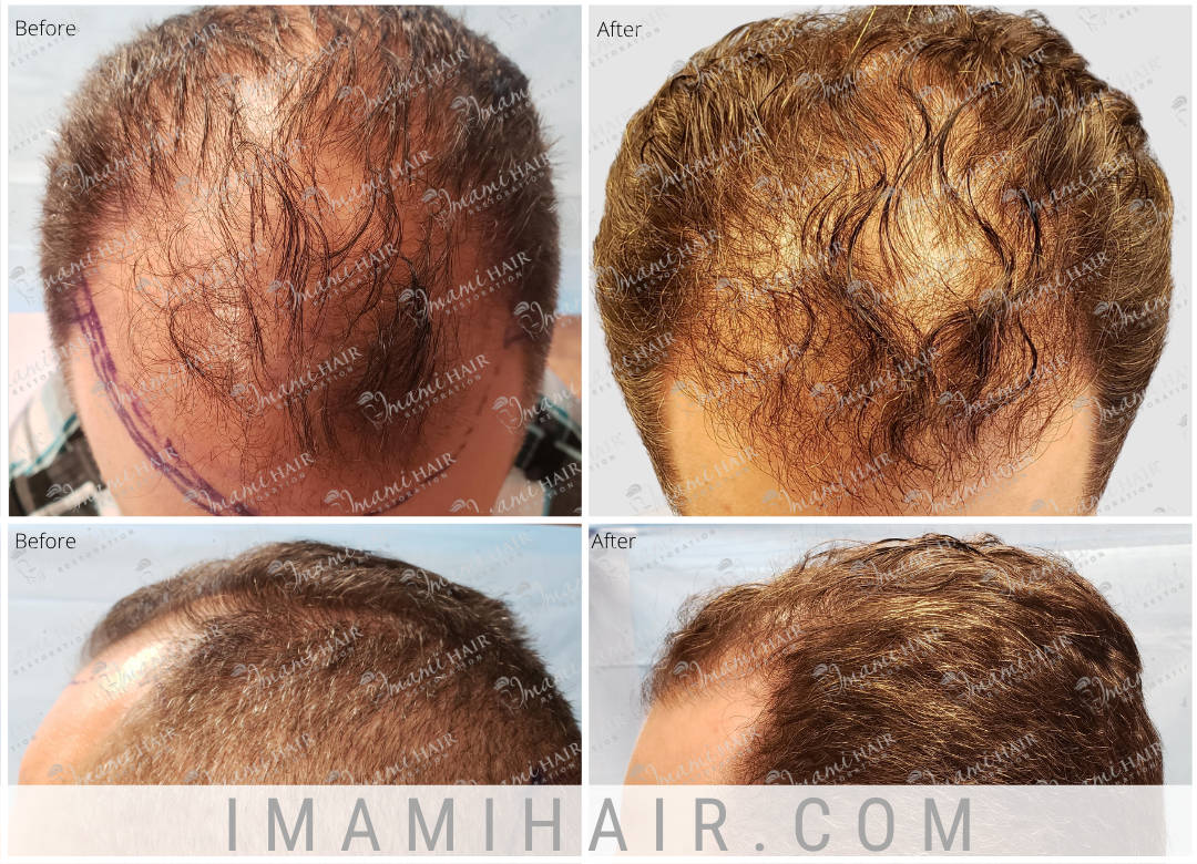 Imami Hair Restoration | Hair Transplants and Hair Loss Treatments