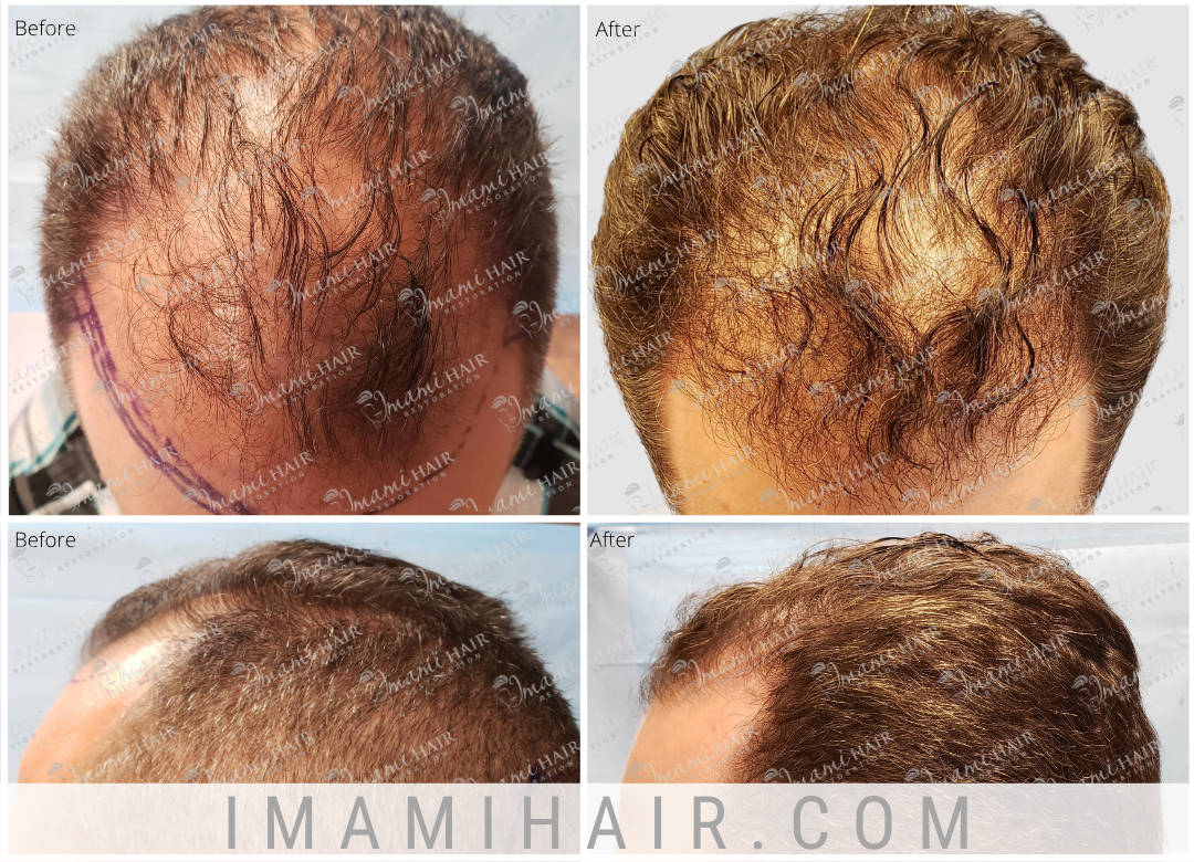 Imami Hair Restoration | Hair Transplants and Hair Loss Treatments Imami Hair Restoration | Hair Transplants and Hair Loss Treatments