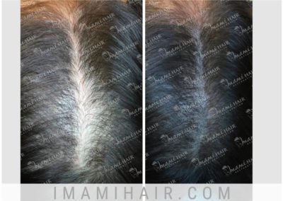 Female: Scalp Micropigmentation