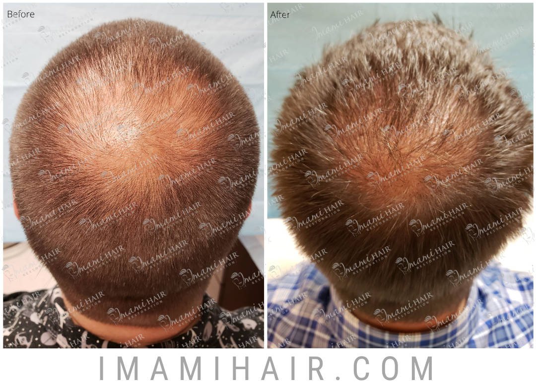 Imami Hair Restoration | Hair Transplants and Hair Loss Treatments Imami Hair Restoration | Hair Transplants and Hair Loss Treatments