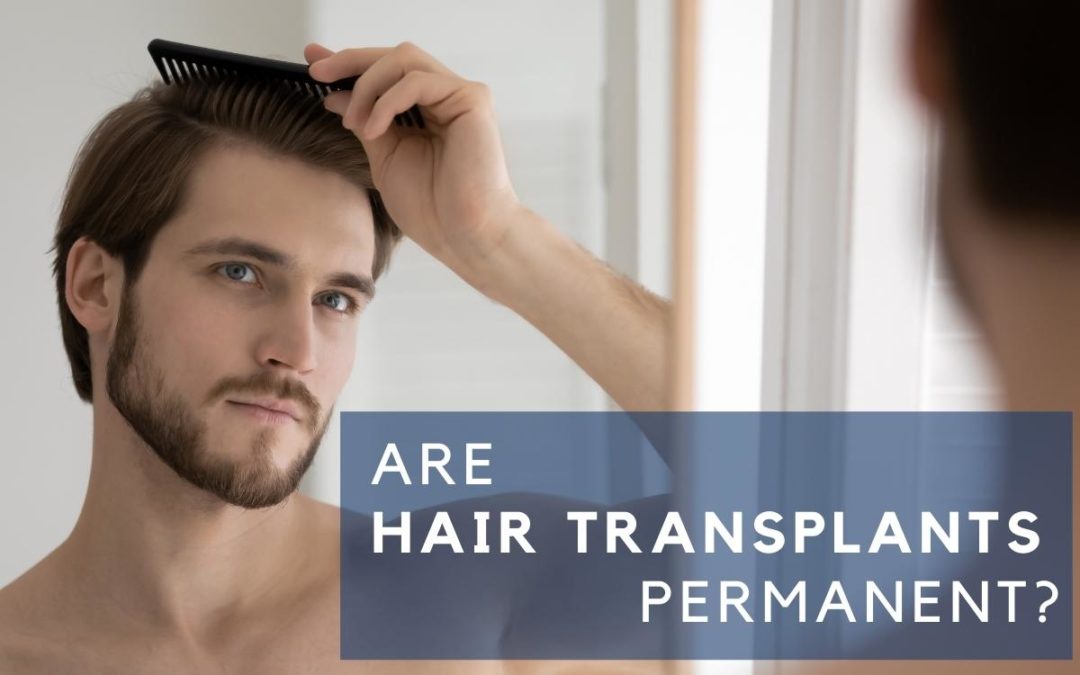 Are Hair Transplants Permanent? How Long Do They Last?