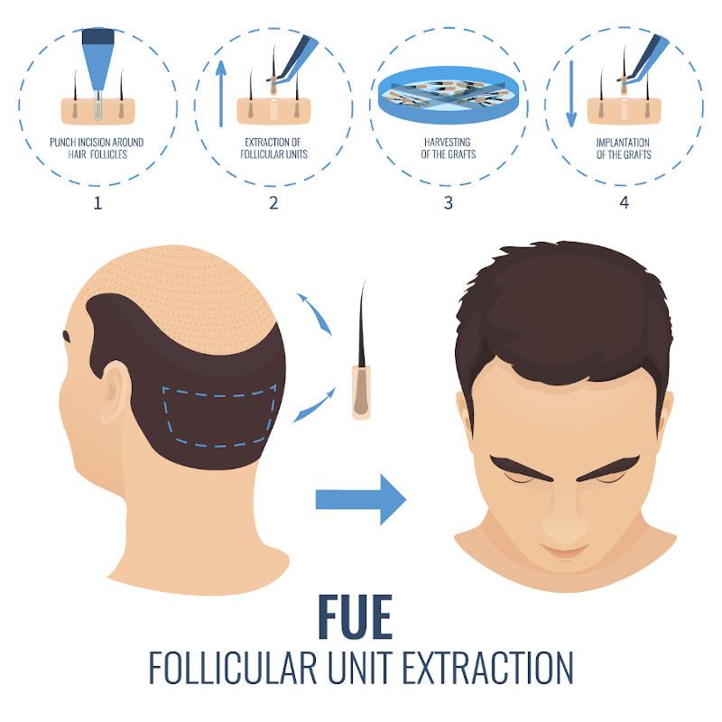 FUE Diagram