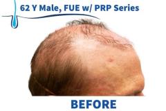 62 Y Male, FUE 