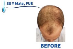 38 Y Male, FUE