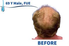69 Y Male, FUE