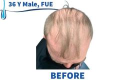 36 Y Male, FUE 