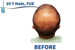 39 Y Male, FUE 