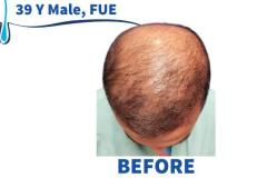 39 Y Male, FUE 