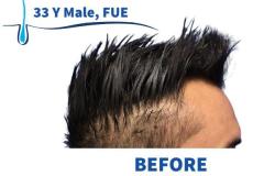 33 Y Male, FUE 