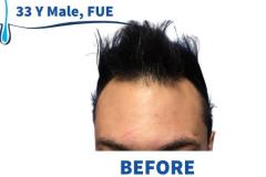 33 Y Male, FUE  