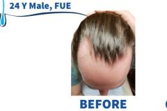 24 Y Male, FUE 