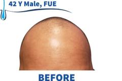 42 Y Male, FUE