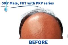 50 Y Male, FUT