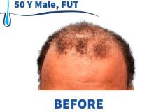 50 Y Male, FUT