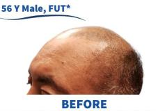 56 Y Male, FUT