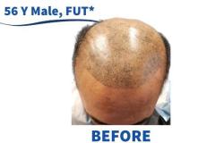 56 Y Male, FUT 